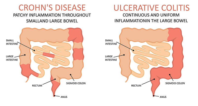 Inflammatory Bowel Disease Ibd Thesurgeons Pte Ltd