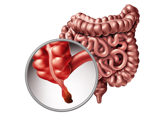 Phẫu thuật ruột thừa Singapore