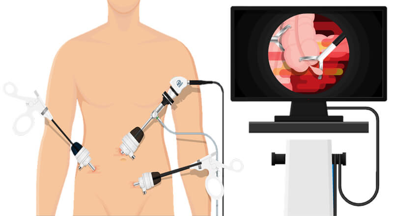 Kanker Kolorektal Singapura