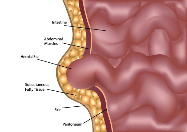 新加坡疝气手术
