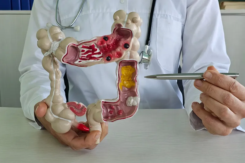 Colon specialist explaining to patient using colorectal anatomy model
