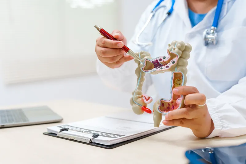 Colon cancer specialist explaining to a patient with a colon anatomy model