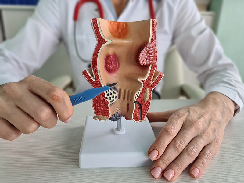 Doctor holding a rectum model while preparing to explain haemorrhoid surgery procedures.
