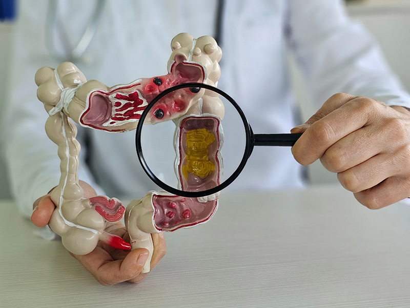 Colorectal specialist explaining Crohn's disease with an anatomical model