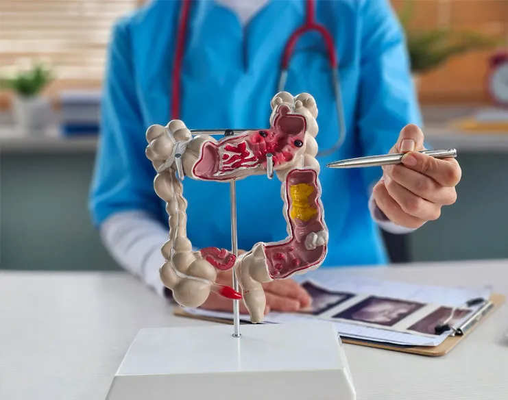 Doctor holding an anatomical model of the colon highlighting colorectal diseases.