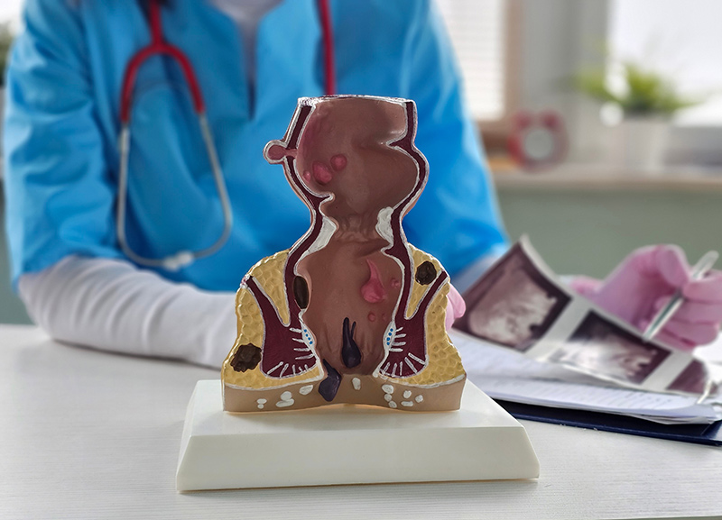 Colorectal specialist with an anatomical model of haemorrhoids